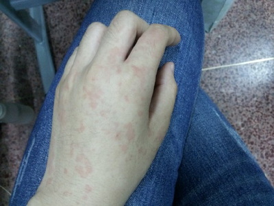 得了荨麻疹怎么治疗比较好