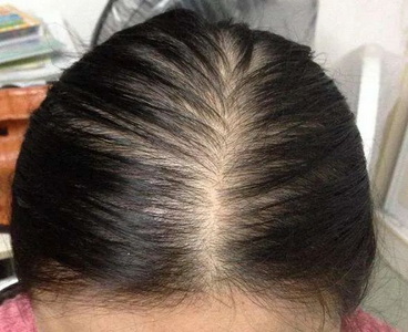 如何才能治疗脱发