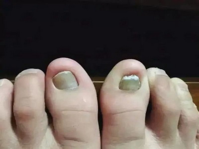 灰指甲都有哪些常见症状